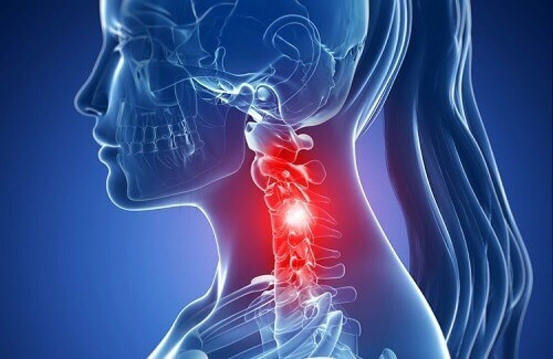 a legjobb komplex a nyaki osteochondrosis számára a nyaki gerinc osteoarthritis